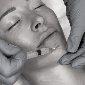 PRP Hair Restoration and Facial Rejuvenation