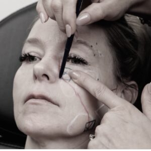 Lifted By Lindsay: Sculptra Face And Body Injections