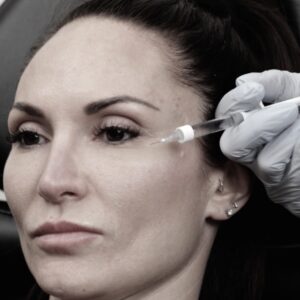 Lifted By Lindsay: Upper Face Hyaluronic Acid Filler Injections