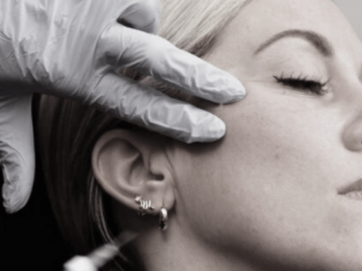 Lifted By Lindsay: Sculptra Face And Body Injections